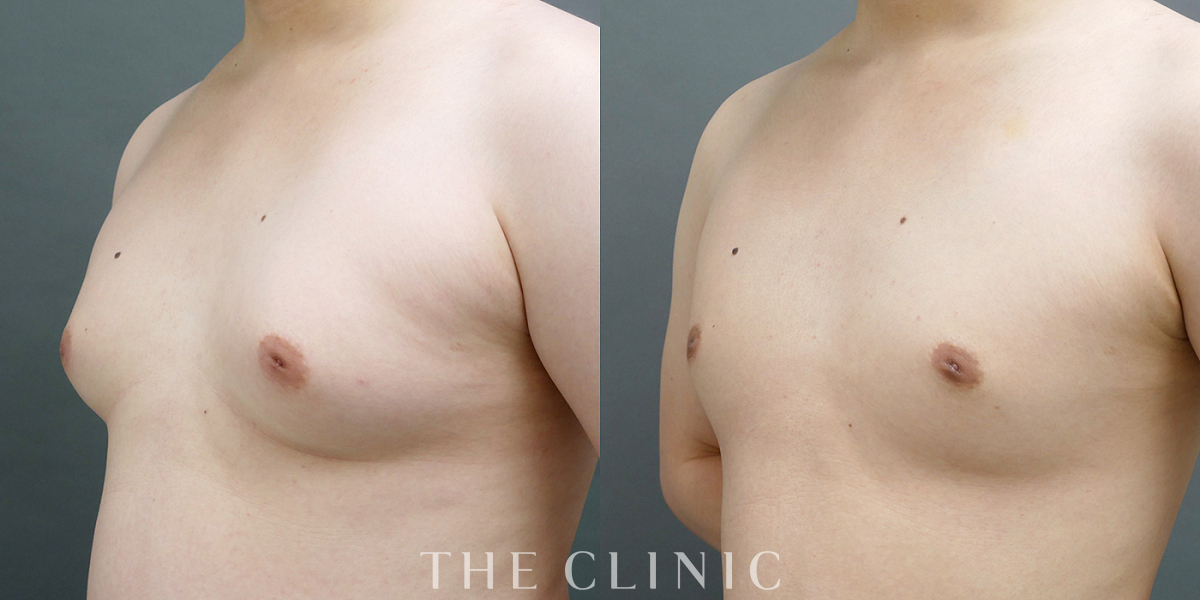 女性化乳房治療(男性の胸の膨らみ改善)の術前／術後