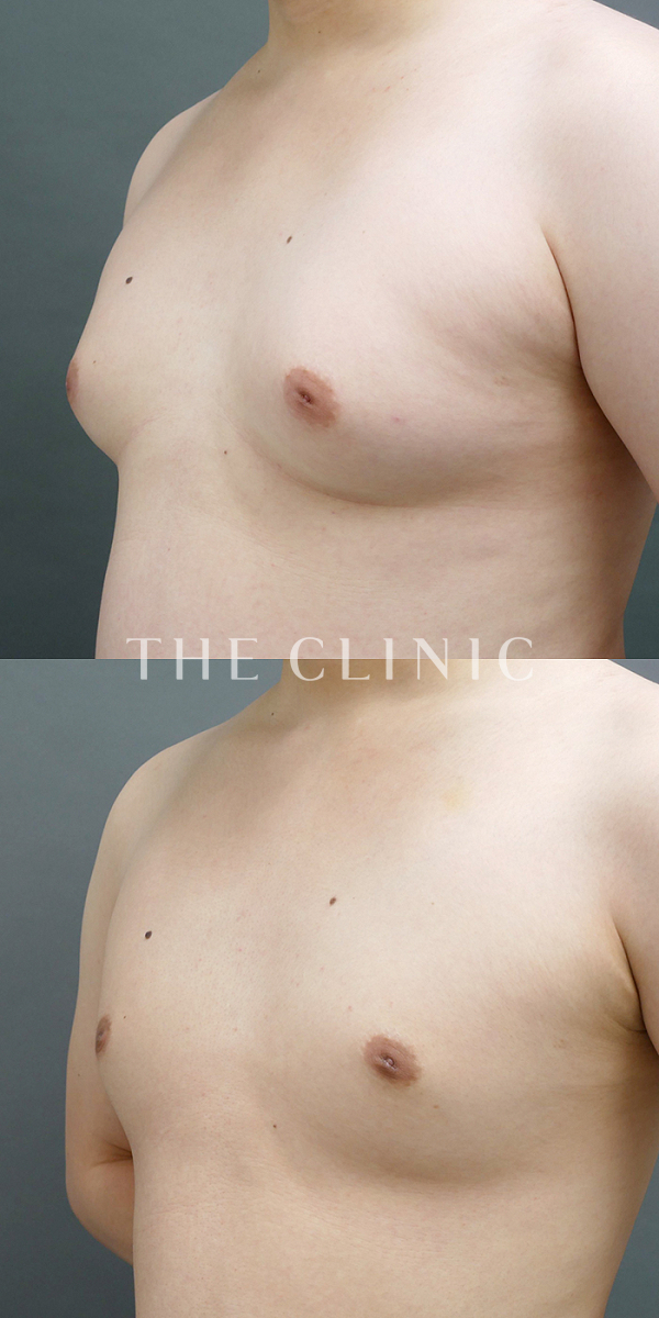 偽性女性化乳房の女性化乳房治療(男性の胸の膨らみ改善)（26歳男性）の術前・術後写真