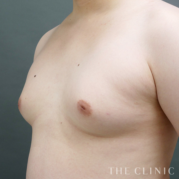 偽性女性化乳房の女性化乳房治療(男性の胸の膨らみ改善)（26歳男性）の術前写真