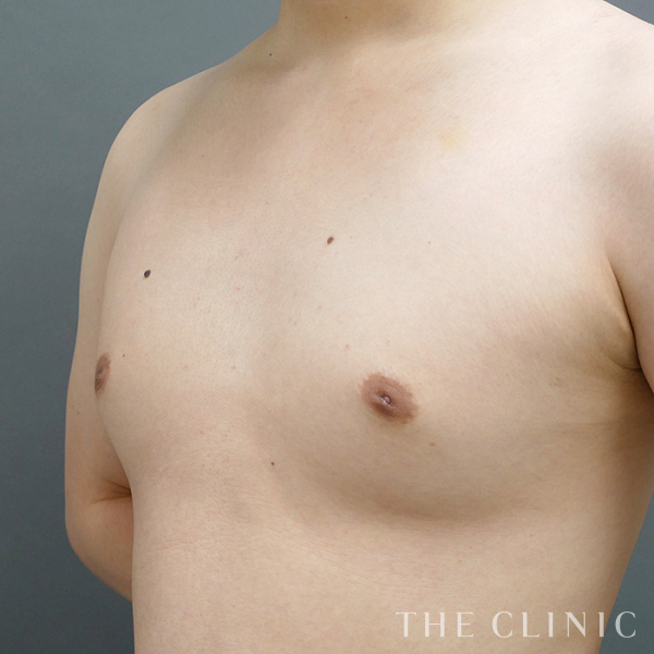 偽性女性化乳房の女性化乳房治療(男性の胸の膨らみ改善)（26歳男性）の術後写真