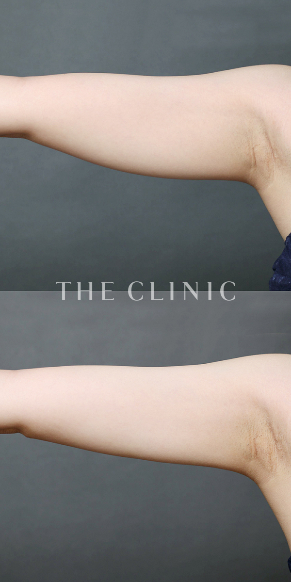 二の腕のベイザー脂肪吸引（28歳女性）の術前・術後写真