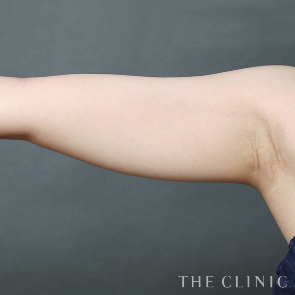 二の腕のベイザー脂肪吸引（28歳女性）の術前写真