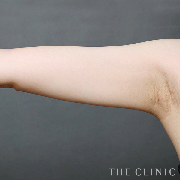 二の腕のベイザー脂肪吸引（28歳女性）の術後写真