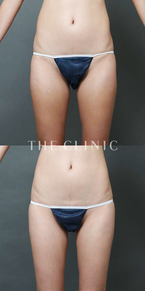 太もものベイザー脂肪吸引（38歳女性）の術前・術後写真