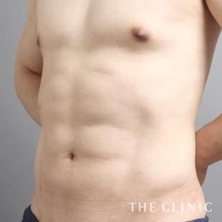 SIX PACK 6つに割れた腹筋のベイザー4D(男性のシックスパック脂肪吸引)のモニター(40代)術後症例画像