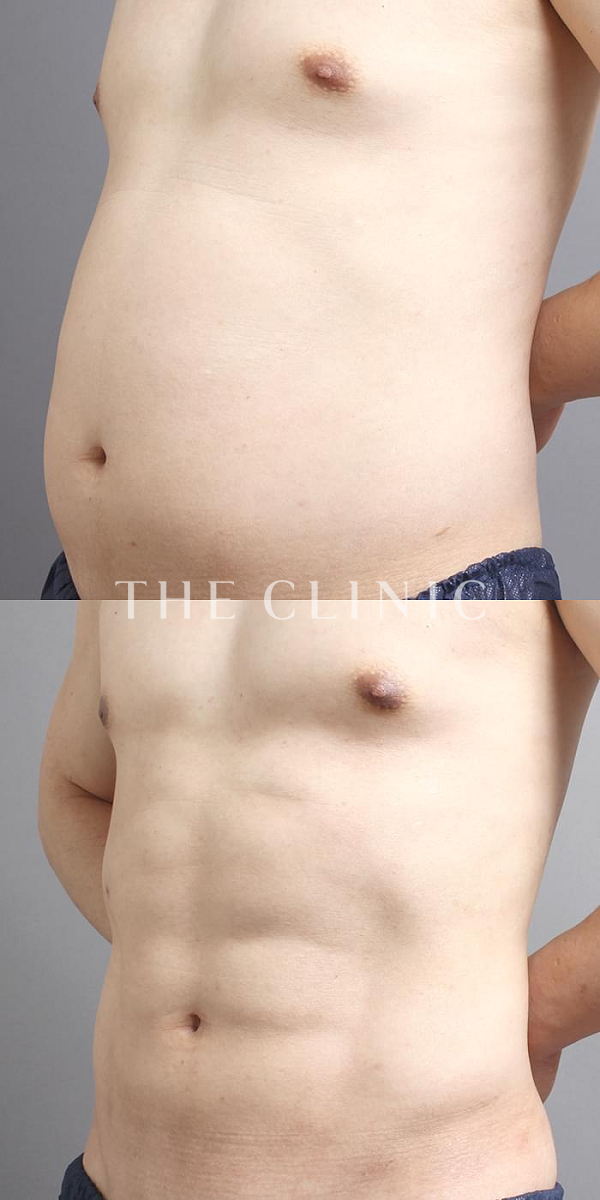 SIX PACK ６つに割れた腹筋のベイザー4D(男性のシックスパック脂肪吸引)（45歳男性）の術前・術後写真