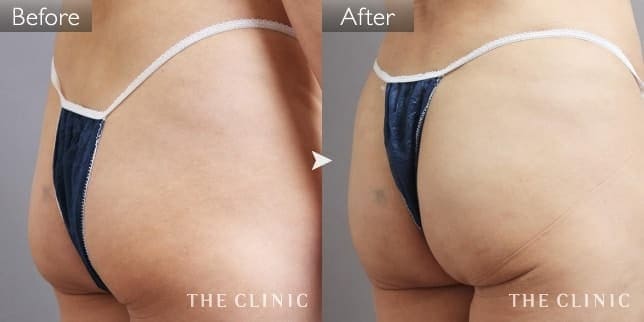 ヒップアップ(女性/53歳)