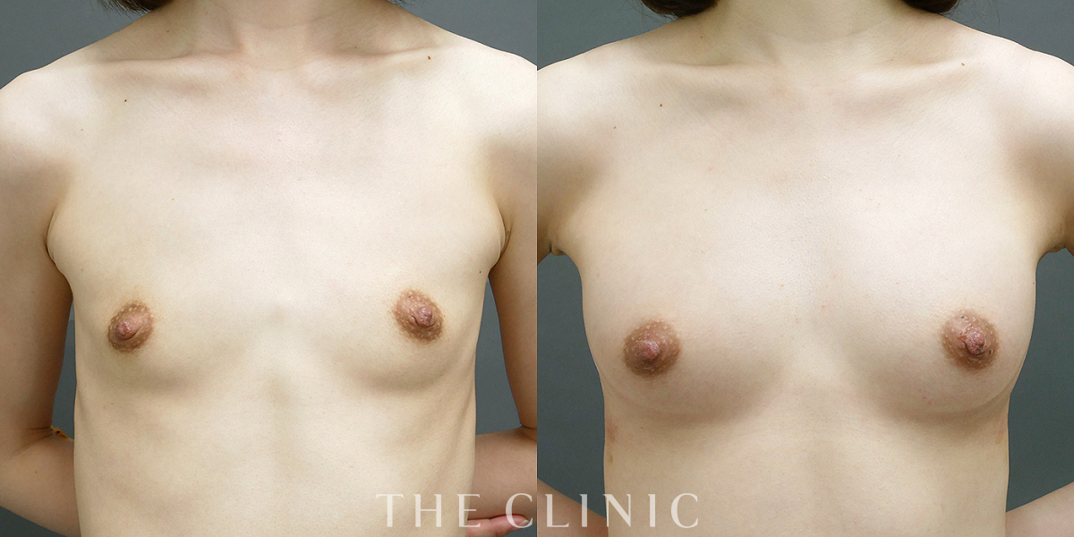 コンデンスビブラ豊胸の術前/術後