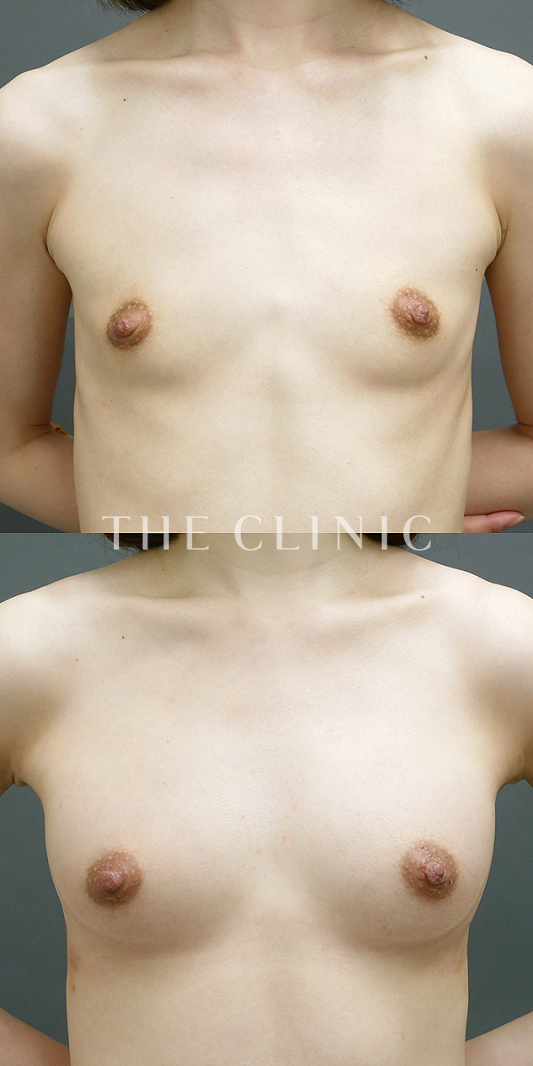 ボリュームアップのコンデンスビブラ豊胸（29歳女性）の術前・術後写真