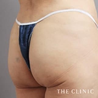 【THE CLINIC 症例画像】No.124_2_ヒップアップ_4D脂肪吸引(4Dリポ)(執刀医：)