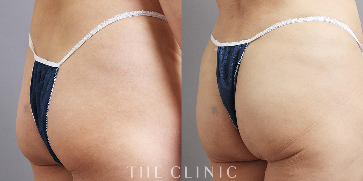 4D脂肪吸引(4Dリポ)の術前/術後