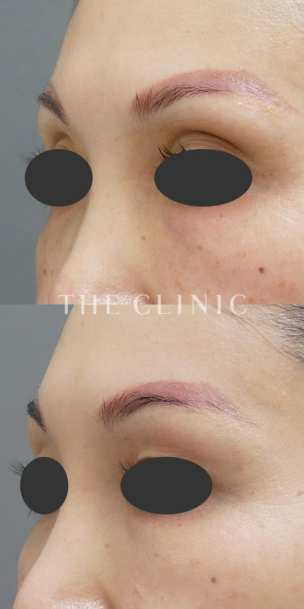 目の上のくぼみのマイクロCRF注入(顔の脂肪注入)（46歳女性）の術前・術後写真