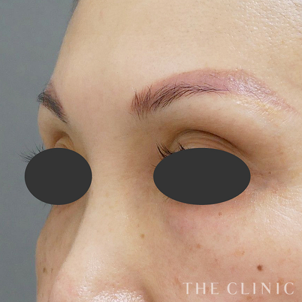 目の上のくぼみのマイクロCRF注入(顔の脂肪注入)（46歳女性）の術前写真