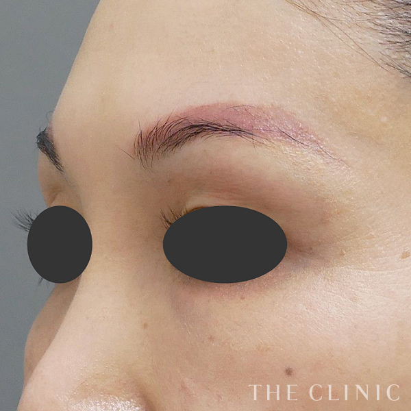 目の上のくぼみのマイクロCRF注入(顔の脂肪注入)（46歳女性）の術後写真