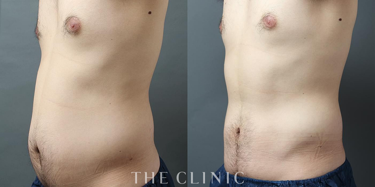 360脂肪吸引®の術前／術後