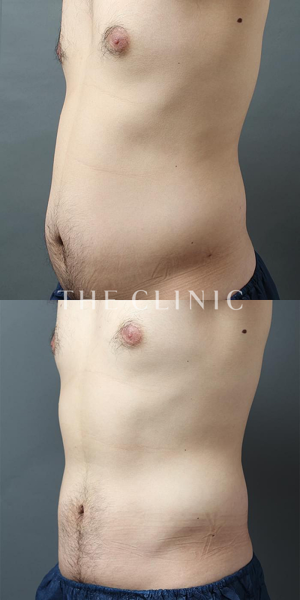 腹部の360脂肪吸引®（28歳男性）の術前・術後写真