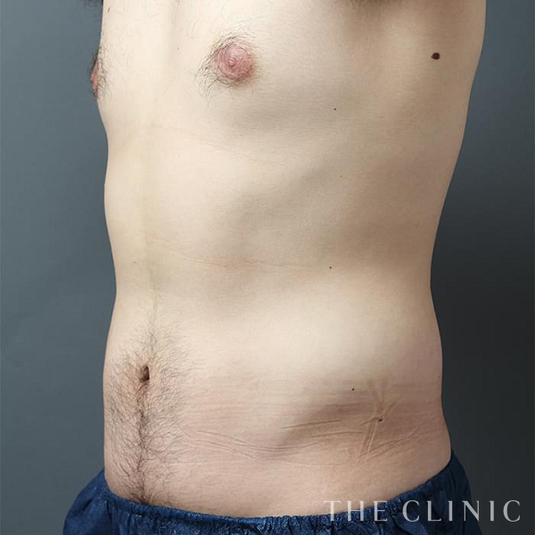 腹部の360脂肪吸引®（28歳男性）の術後写真