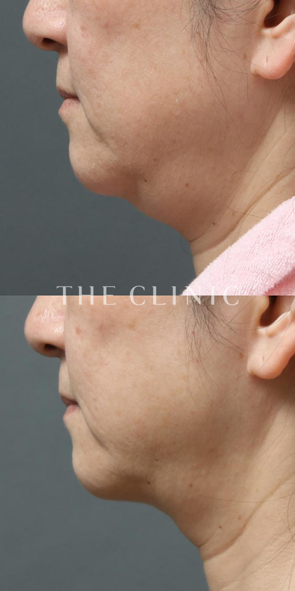 頰／顎の360脂肪吸引®（52歳女性）の術前・術後写真