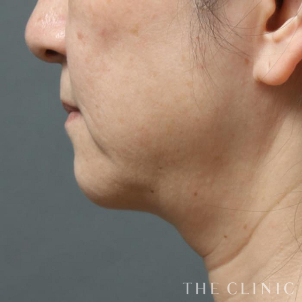 頰／顎の360脂肪吸引®（52歳女性）の術後写真