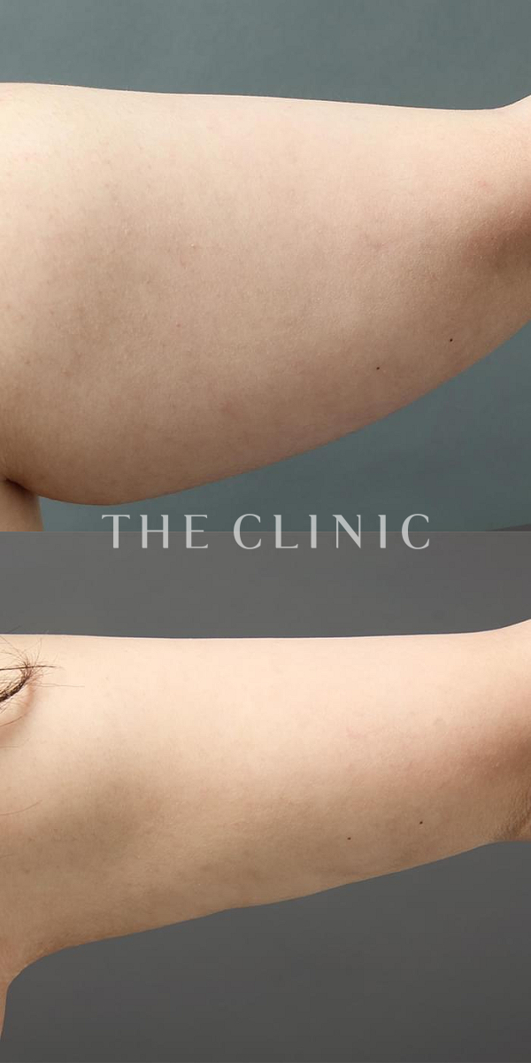 二の腕のベイザー脂肪吸引（27歳女性）の術前・術後写真