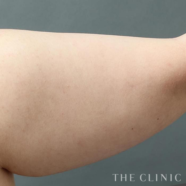 二の腕のベイザー脂肪吸引（27歳女性）の術前写真