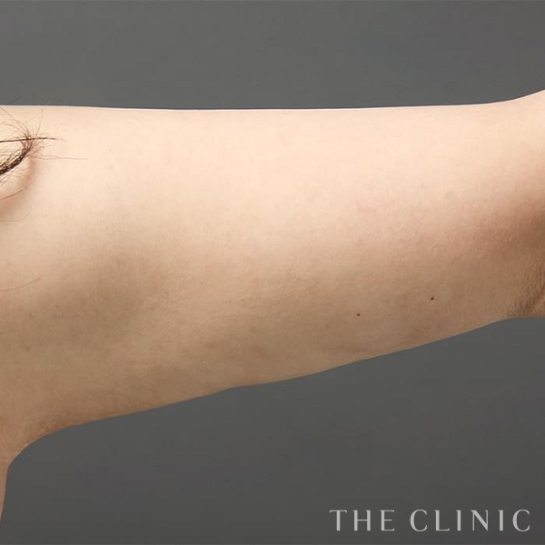 二の腕のベイザー脂肪吸引（27歳女性）の術後写真