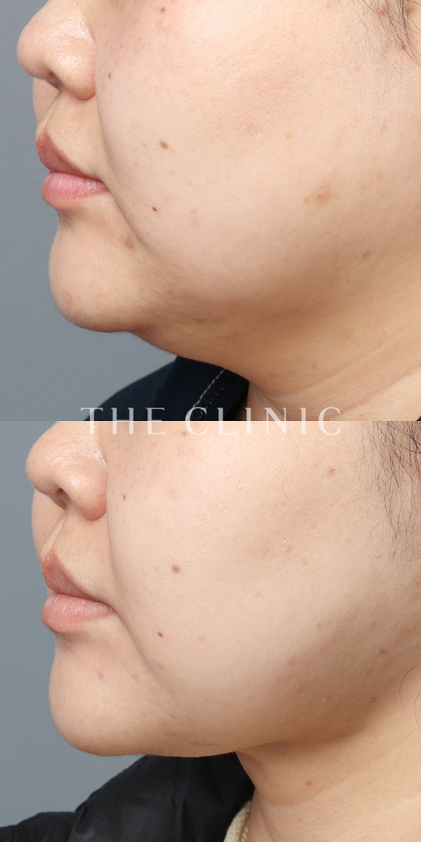 頰／顎のベイザー脂肪吸引（35歳女性）の術前・術後写真