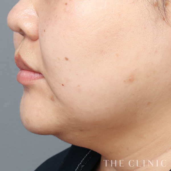 頰／顎のベイザー脂肪吸引（35歳女性）の術前写真