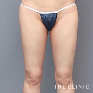【THE CLINIC 症例画像】No.1289_2_太もも_ベイザー脂肪吸引(執刀医：今西 理也)