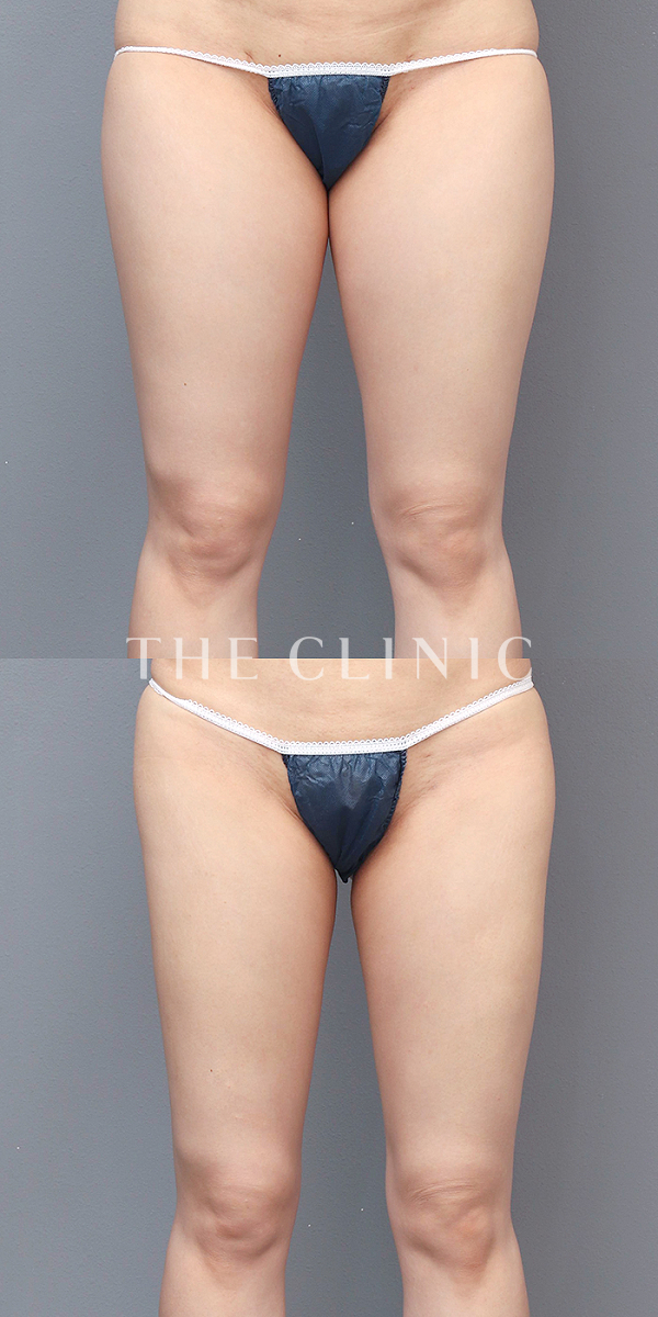 太もものベイザー脂肪吸引（29歳女性）の術前・術後写真