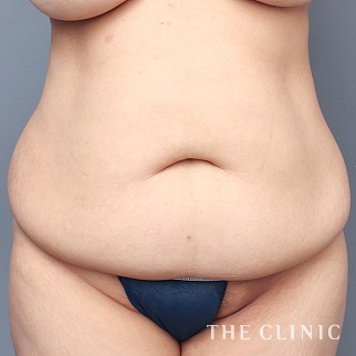 腹部／腰・ウエストのベイザー脂肪吸引のモニター（40代）術前症例画像