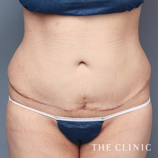 【THE CLINIC 症例画像】No.1295_2_腹部_タミータック4D(お腹のたるみ解消)(執刀医:村田 八千穂)