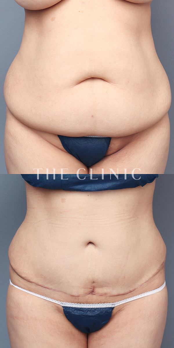 腹部・腰・ウエストのベイザー脂肪吸引（43歳女性）の術前・術後写真