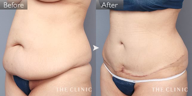 脂肪吸引 腹部/腰・ウエスト 症例写真