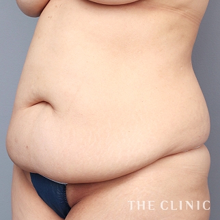 【THE CLINIC 症例画像】No.1296_1_腹部_タミータック4D(お腹のたるみ解消)(執刀医:村田 八千穂)