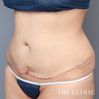 【THE CLINIC 症例画像】No.1296_2_腹部_タミータック4D(お腹のたるみ解消)(執刀医:村田 八千穂)