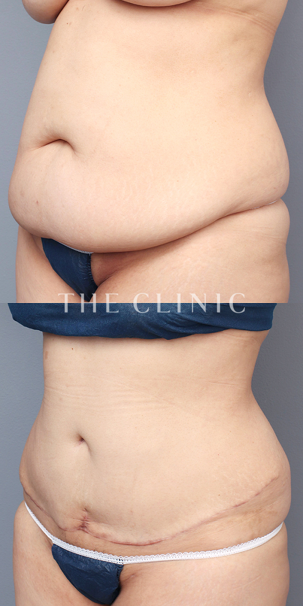 腹部・腰・ウエストのベイザー脂肪吸引（43歳女性）の術前・術後写真