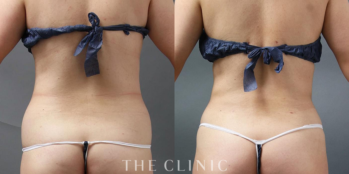 背中の360脂肪吸引®（30歳女性）の術前／術後