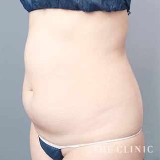 【THE CLINIC 症例画像】No.1300_1_腹部_360脂肪吸引®(執刀医:今西 理也)