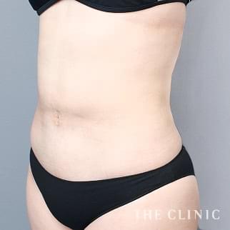 【THE CLINIC 症例画像】No.1300_2_腹部_360脂肪吸引®(執刀医:今西 理也)
