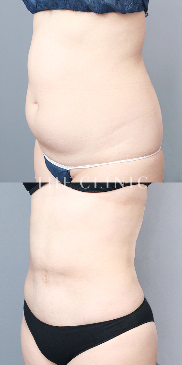 腹部のベイザー脂肪吸引（29歳女性）の術前・術後写真
