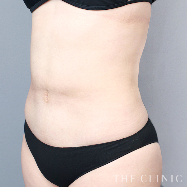 腹部のベイザー脂肪吸引（29歳女性）の術後写真
