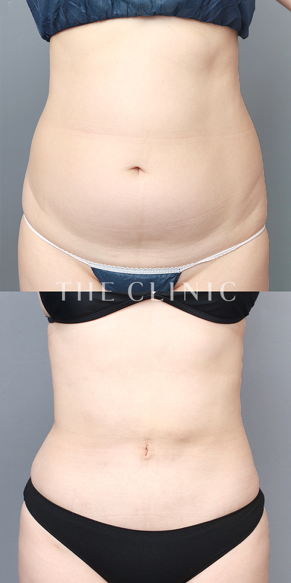 腹部のベイザー脂肪吸引（29歳女性）の術前・術後写真