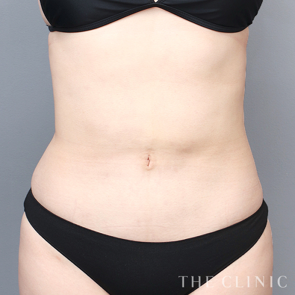 腹部のベイザー脂肪吸引（29歳女性）の術後写真