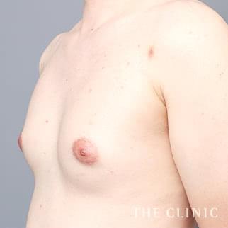 女性化乳房の女性化乳房治療(男性の胸の膨らみ改善)のモニター(30代)術前症例画像