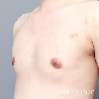 女性化乳房の女性化乳房治療(男性の胸の膨らみ改善)のモニター(30代)術後症例画像