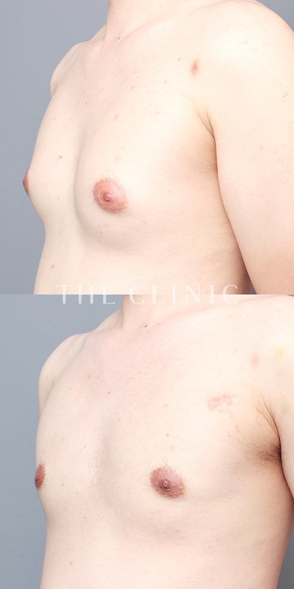 女性化乳房の女性化乳房治療(男性の胸の膨らみ改善)（33歳男性）の術前・術後写真