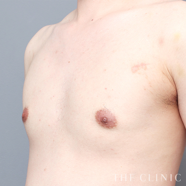 女性化乳房の女性化乳房治療(男性の胸の膨らみ改善)（33歳男性）の術後写真