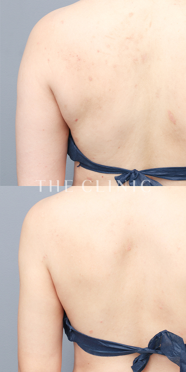 二の腕・腕の付け根のベイザー脂肪吸引（38歳女性）の術前・術後写真