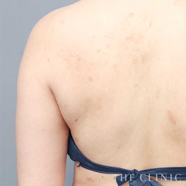 二の腕・腕の付け根のベイザー脂肪吸引（38歳女性）の術前写真